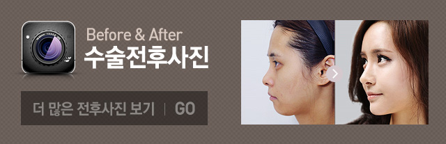 수술전후사진